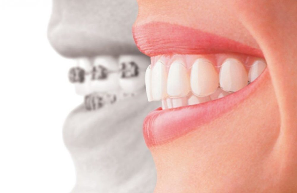 Braces - Wallan Dentist, Riddells Creek Dentist and Maribyrnong Dentist