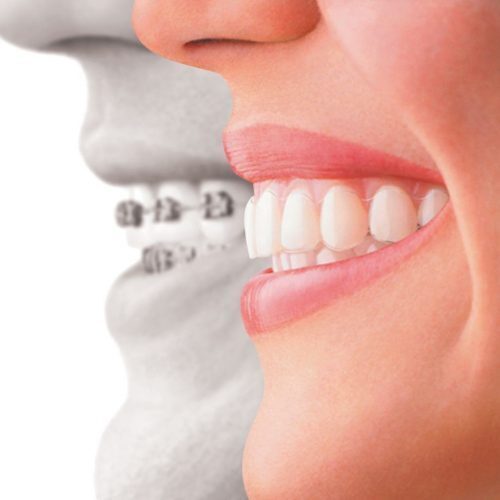 Braces - Wallan Dentist, Riddells Creek Dentist and Maribyrnong Dentist