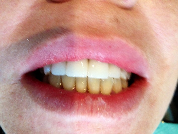 Cosmetic Crowns - After