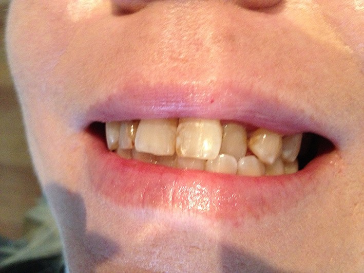 Cosmetic Crowns - Before