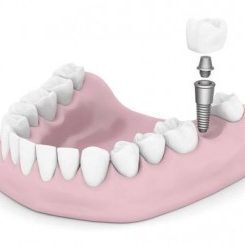 Dental Implants - Dentist Wallan and Riddell Creek
