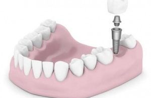 Dental Implants - Dentist Wallan and Riddell Creek