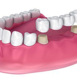 Cosmetic Crowns - Wallan Dentist, Riddells Creek Dentist and Maribyrnong Dentist
