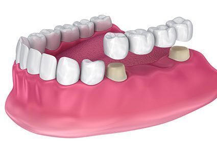 Cosmetic Crowns - Wallan Dentist, Riddells Creek Dentist and Maribyrnong Dentist