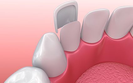 Veneer - Wallan Dentist, Riddells Creek Dentist and Maribyrnong Dentist