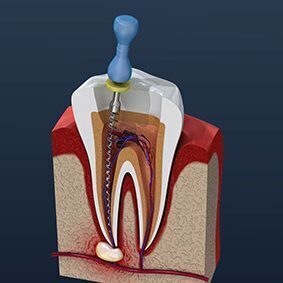 Root Canal - Wallan Dentist, Riddells Creek Dentist and Maribyrnong Dentist