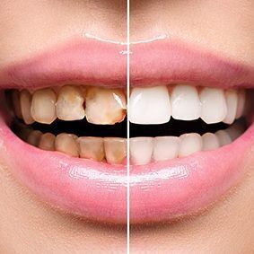 Smile makeover - Wallan Dentist, Riddells Creek Dentist and Maribyrnong Dentist