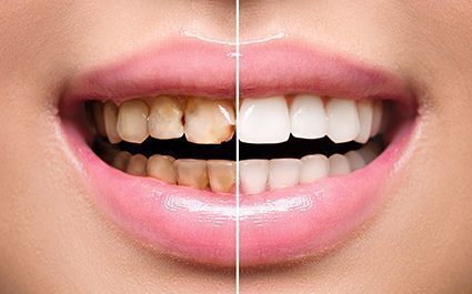 Smile makeover - Wallan Dentist, Riddells Creek Dentist and Maribyrnong Dentist