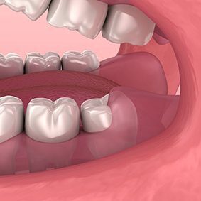 Wisdom Teeth Extraction - Wallan Dentist, Riddells Creek Dentist and Maribyrnong Dentist