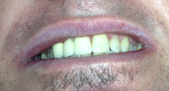 Fixed Bridge - After