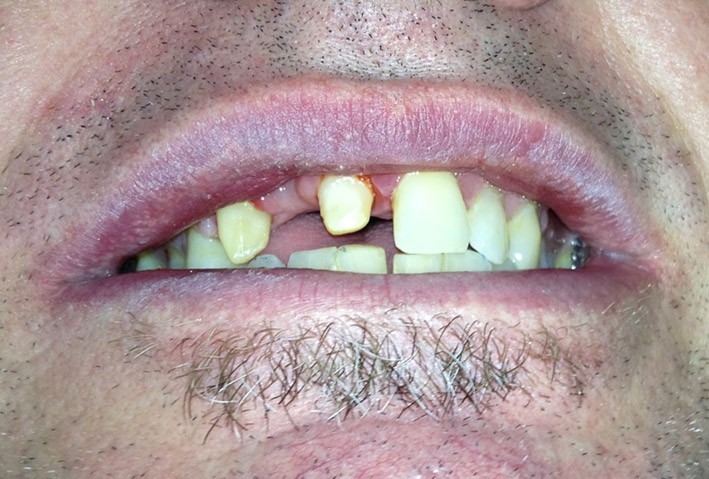 Fixed Bridge - Before