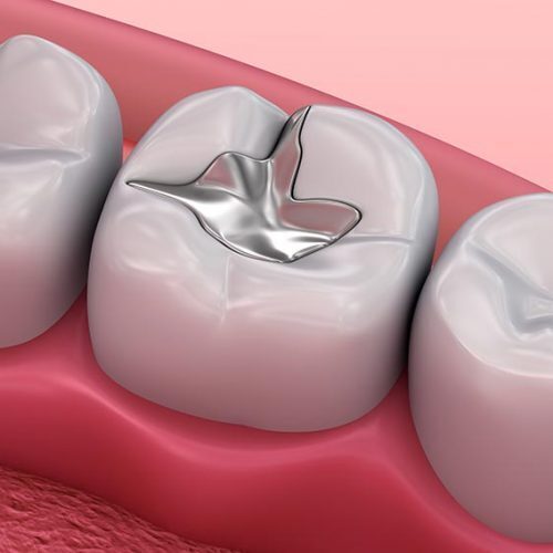 Fillings Dentist Riddells Creek Wallan Maribyrnong