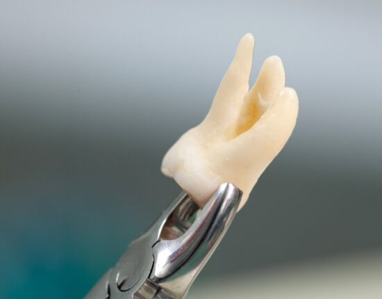 Wisdom Teeth Extraction