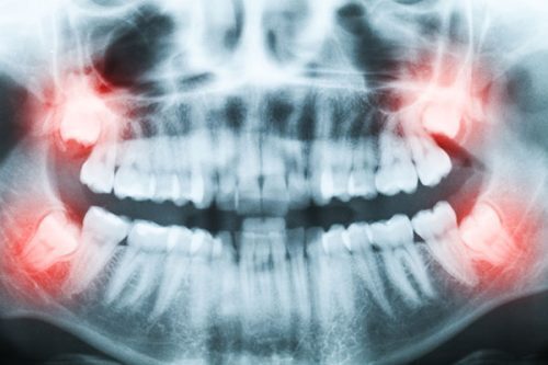 wallan dentist , Wisdom Tooth Extraction